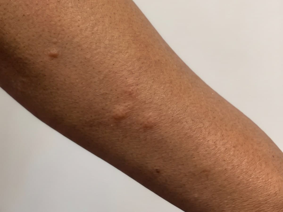 A forearm with several raised, pink bite marks, three of them close together, against a plain pale background.